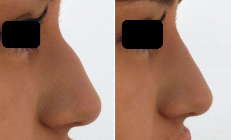 rhinoplastie médicale sans operation