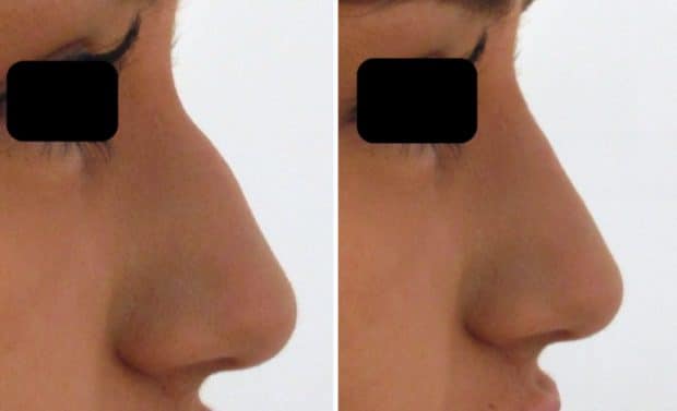 Rhinoplastie médicale par acide Hyaluronique
