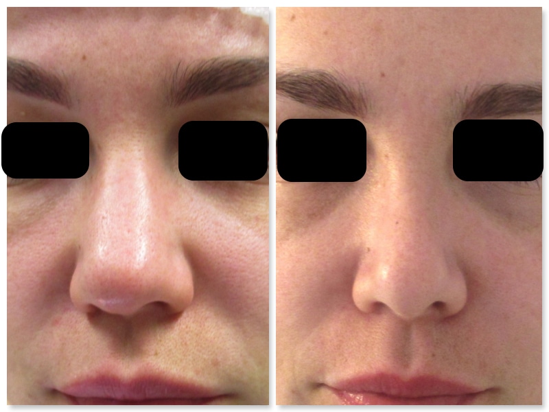 Resultat-rhinoplastie-de-face