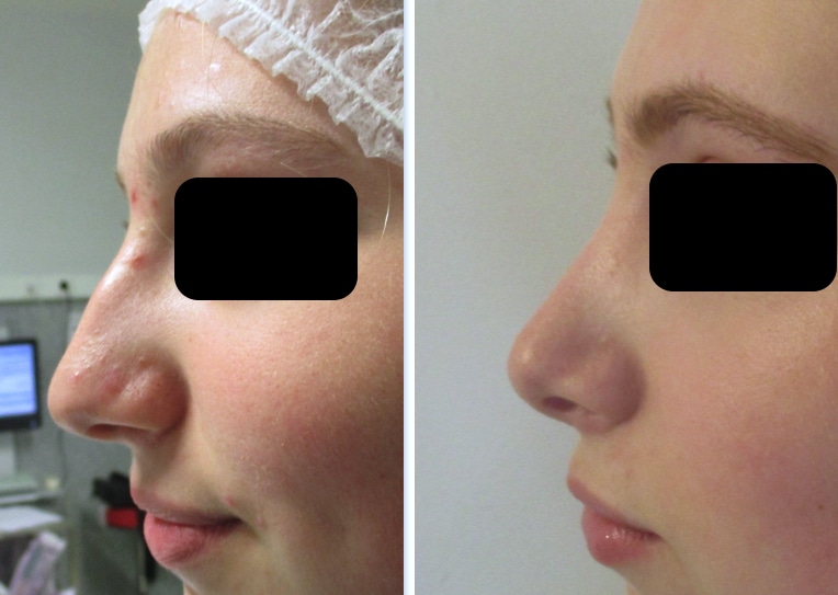 rhinoplastie-diminuant-pointe-bosse-projection