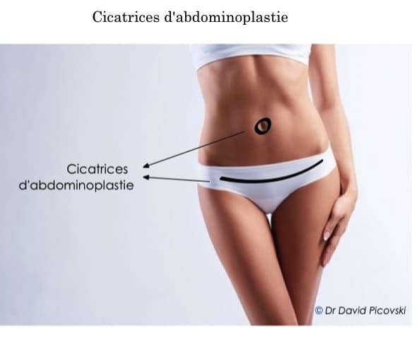 Disposition des cicatrices pour une abdominoplastie complète avec repositionnement ombilical