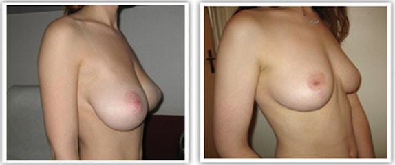 Résultat d'un lifting de seins avec réduction de la taille de la poitrine permettant de passer d'un bonnet D à un bonnet B
