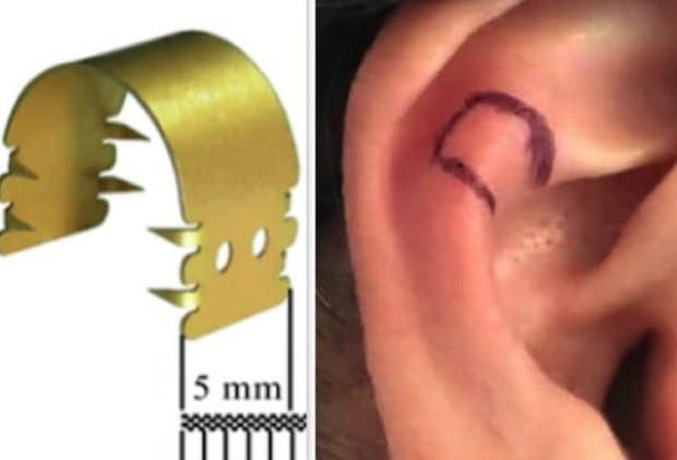 Correction d'oreilles décollées sans chirurgie par implants Earfold®.