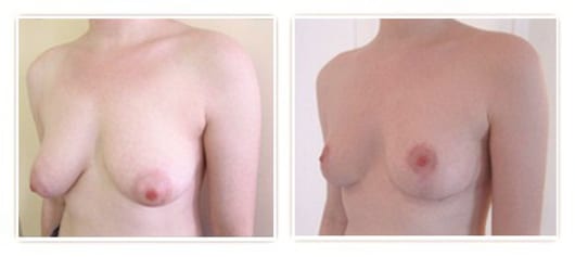 lifting mammaire sans implants à cicatrice en t à 3 semaines