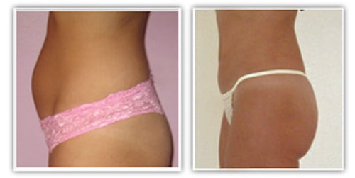 lipoaspiration seule de l'abdomen sans cicatrice