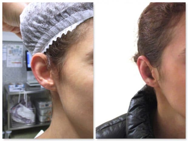 Résultat à l'ouverture du premier pansement le lendemain d'une chirurgie de recollement des oreilles