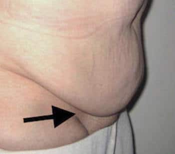 tablier abdominal permettant la prise en charge de l'abdominoplastie