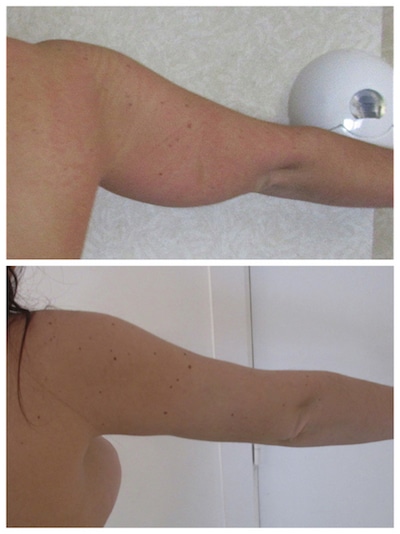 Importance de la liposuccion des bras