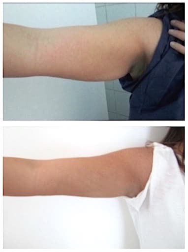 lifting des bras sans cicatrice par liposuccion seule des bras