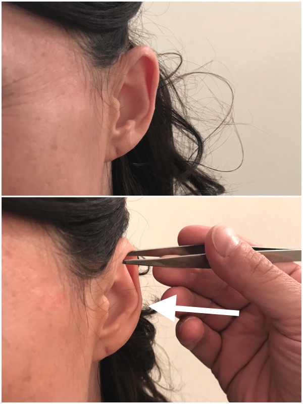 Inconvenient Earfold par rapport à l'otoplastie
