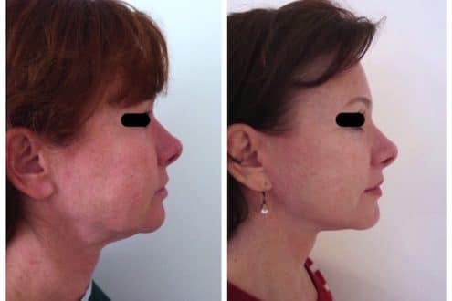 lifting cervico-facial à l'age de 50ans