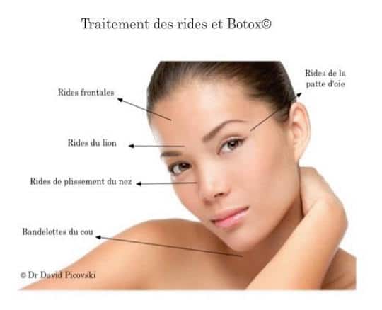 Les zones traitées par le botox