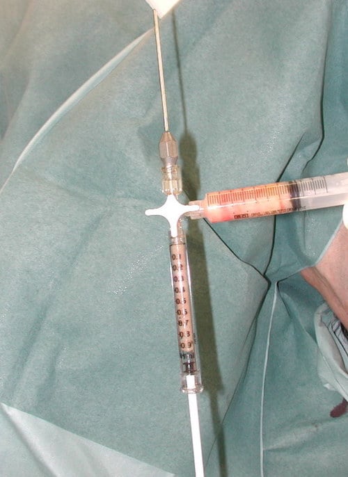 seringue-pour-injection-de-graisse