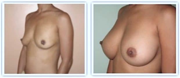 implant-330-augmentation-significative
