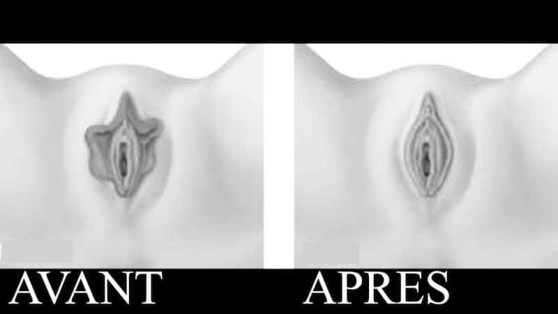 nymphoplastie traitement de l'hypertrophie des petites levres
