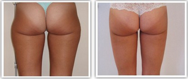 complication de la lipoaspiration
