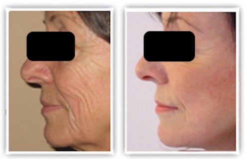 lifting cervico-facial chez une femme de plus de 65 ans