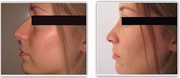 Résultat de rhinoplastie esthétique par voie fermée sans cicatrice externe 