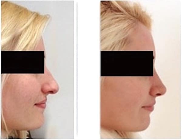 Résultat avant après d'une rhinoplastie enlevant la bosse et diminuant la pointe et la projection