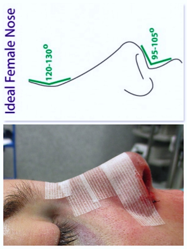 Résultat immédiat avant la mise en place de l'attelle de protection d'une rhinoplastie naturelle 