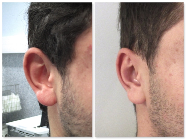 Autre résultat avant-après d'un recollement des oreilles avec lobes