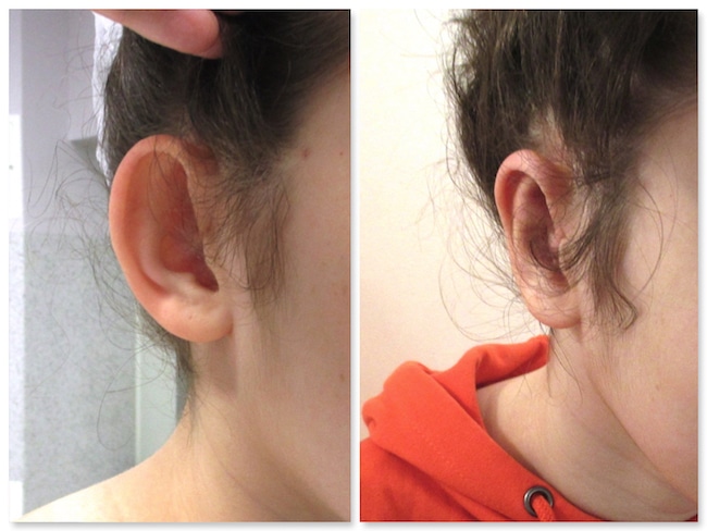 Résultat d'une opération des oreilles décollées chez un enfant