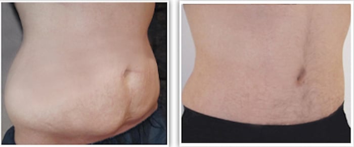 photo-resultat-avant-apres-plastie-abdominale