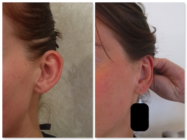 Recollement des oreilles par otoplastie
