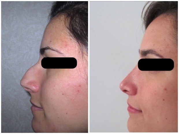 Résultat de rhinoplastie avant/après traitant la bosse et la pointe nez 