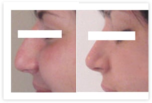 Rhinoplastie avant/après