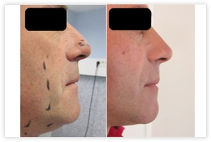 Rhinoplastie chez l'homme