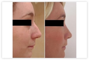 Rhinoplastie pour correction esthétique de la bosse et de la pointe
