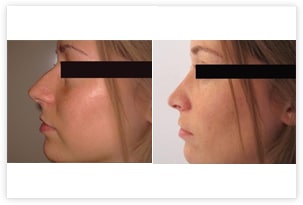 Rhinoplastie esthétique chez une jeune femme