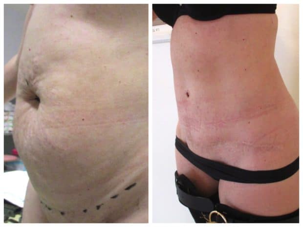 Avant-après : photos du résultat d'une abdominoplastie avec lipoaspiration ventre