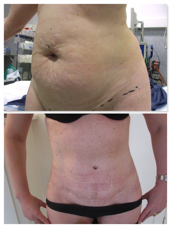 Avant-Après: photo de résultat des cicatrices à un an d'une abdominoplastie complete avec repositionnement ombilical