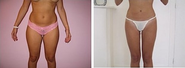 Résultat de lipoaspiration circulaire des cuisses associée à une lipoaspiration du ventre et des hanches