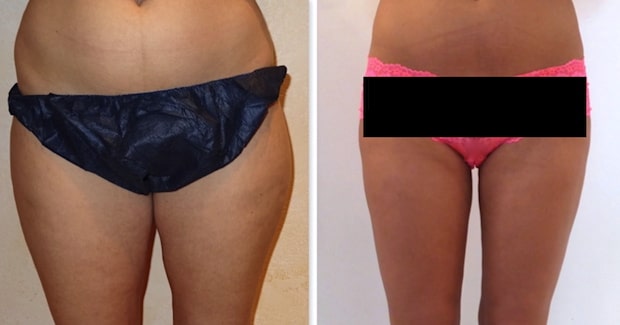 La lipoaspiration a pour but de traiter les graisses résistantes au niveau des cuisses après un régime bien conduit
