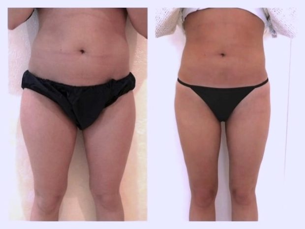 Résulat d'une liposuccion circulaires des cuisses associée à une lipoaspiration des hanches