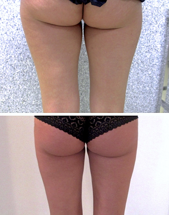 Résultat d'un traitement par liposuccion des faces internes des cuisses et de la culotte de cheval