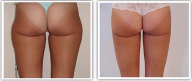 Opération de chirurgie esthétique des cuisses : liposuccion localisée au niveau de la culotte de cheval