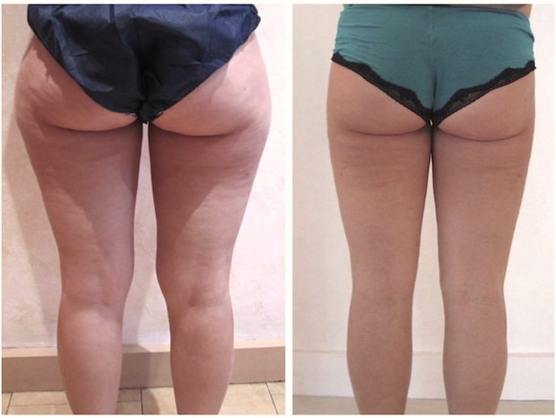 Résultat avant-après d'une liposuccion des la culotte de cheval, des cuisses et des genoux