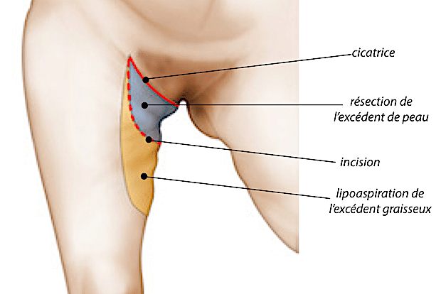 Principe du lifting de cuisses (dermolipectomie de cuisses)