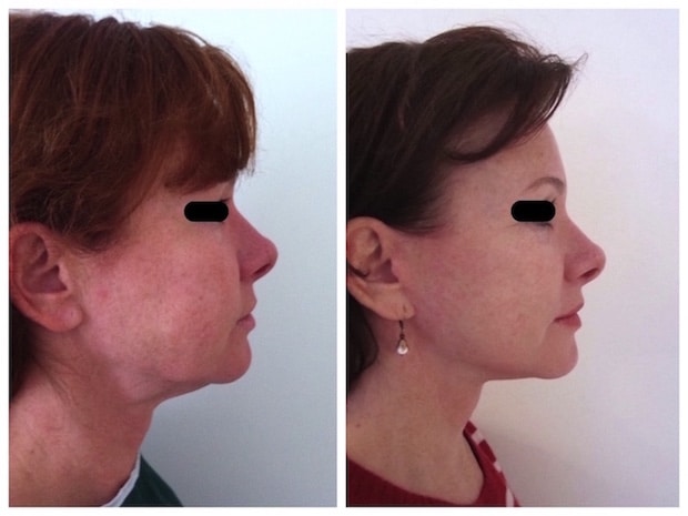 Lipoaspiration du cou combinée à un lifting cervical chez une femme