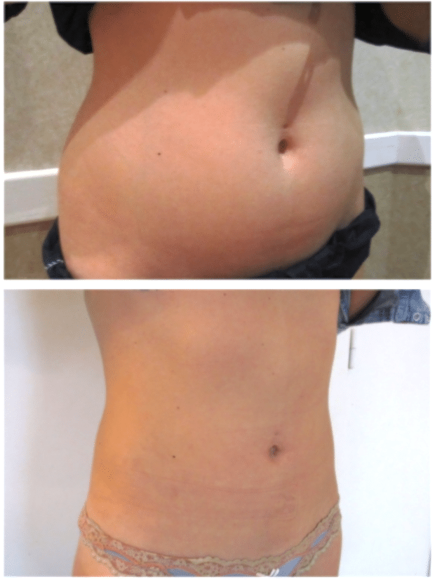 Résultat d'une liposuccion du ventre chez une femme