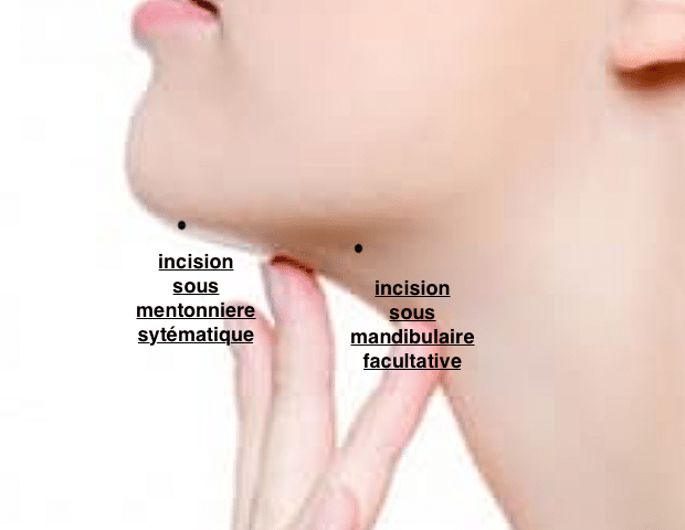 Zones des incisions possibles pour une liposuccion du cou