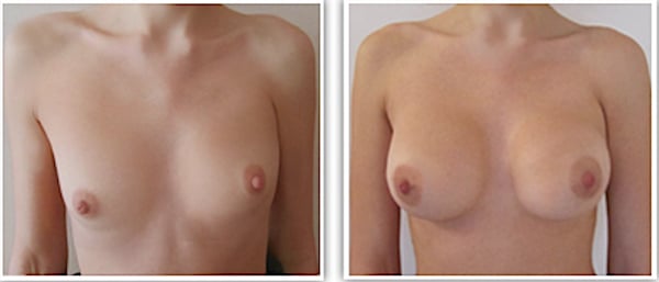 Avant-apr&egrave;s : Chirurgie r&eacute;paratrice par implants d'une hypoplasie unilat&eacute;rale sur syndrome de Poland