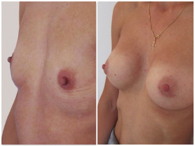 Hypotrophie ou hypoplasie mammaire bilat&eacute;rale s&eacute;v&egrave;re trait&eacute;e par proth&egrave;ses