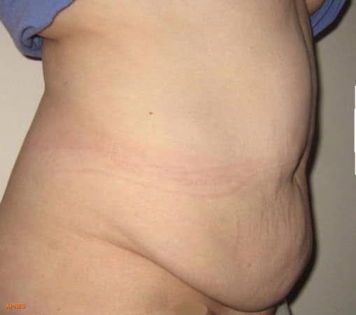 Aspect d'un tablier abdominal (ventre recouvrant le pubis)