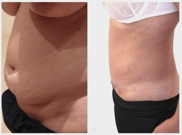 Résultat d'une plastie abdominale associée à une lipoaspiration de l'abdomen et des flancs