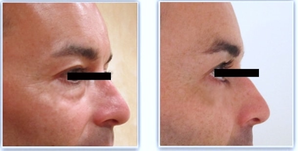 Résultat avant/après blepharoplastie inférieure chez un homme par voie conjonctivale (sans cicatrice) traitant les poches graisseuses 